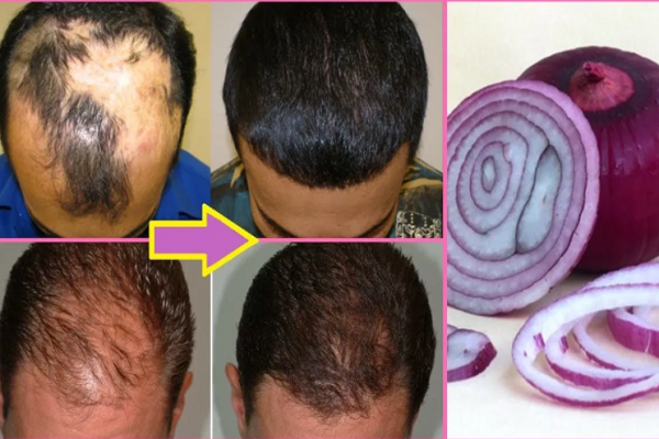  Amazing benefits of onion juice for hair