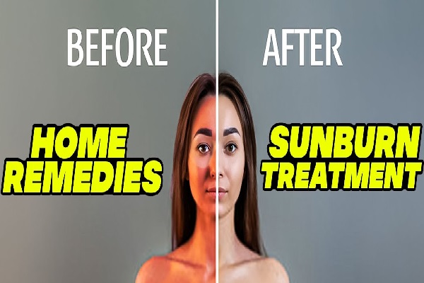  Sunburn Blisters: Diagnosis, Symptoms and treatment
